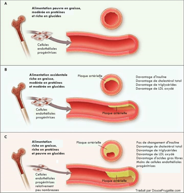 plaque artérielle, alimentation et graisse